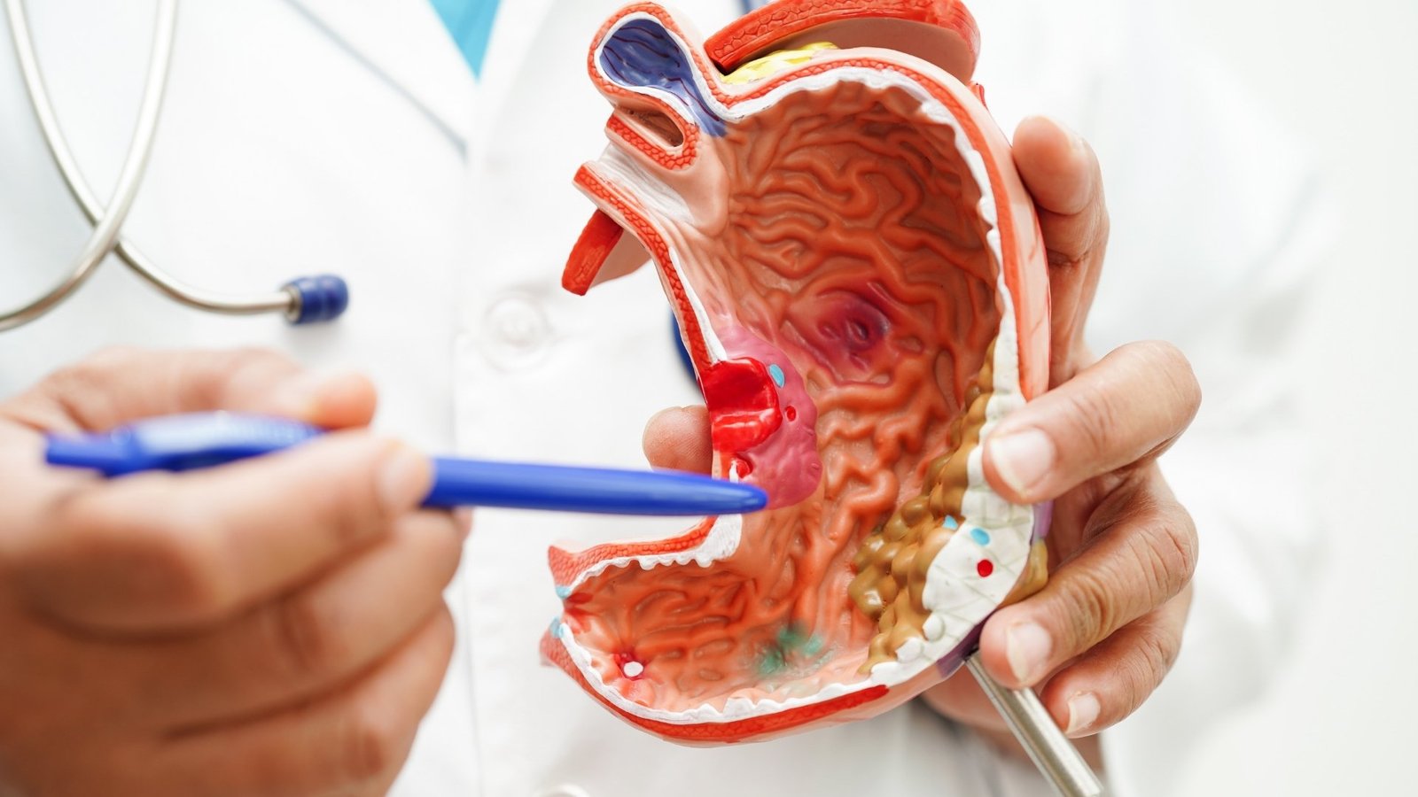 Gastroplastia Endoscópica Sleeve Endoscópico | Bem Star Bem